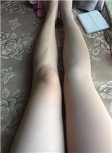 女生腿部淤青图片