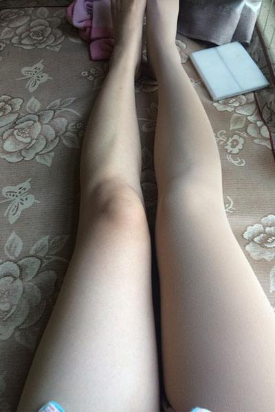 女生腿部淤青图片(点击浏览下一张趣图)