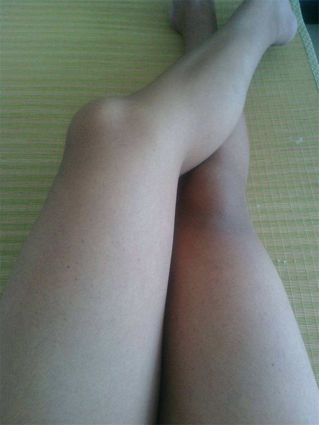 女生膝盖擦伤真实照片(3)(点击浏览下一张趣图)
