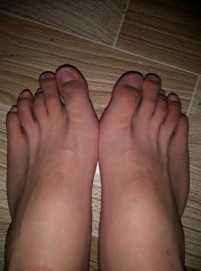 在上高中的时候,发现两只脚的脚趾头伸不直,当脚伸直的时候脚趾呈爪状