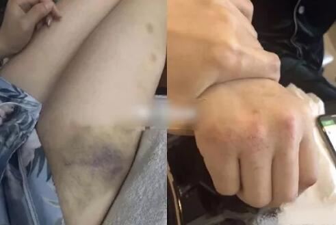 e先生凡达前妻曝光被家暴照片，前妻董小姐直播证实，凡达上电视是事实